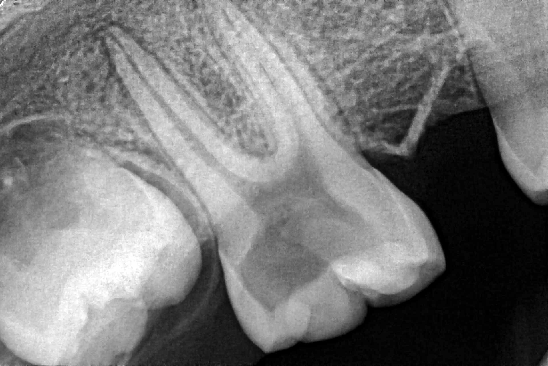 Retro-alveolar x-ray of a maxillary molar undergoing pulpectomy